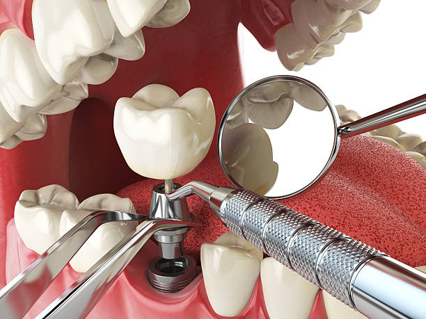 Best Emergency Root Canal Treatment in Trinity, NC